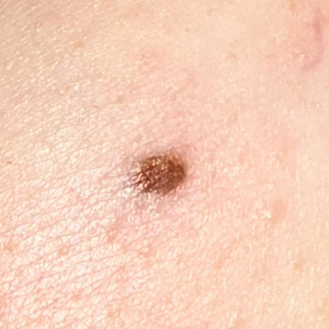 Paramedical Tattoo Artistry - Scar Camouflage + Restoration