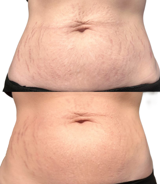 Paramedical Tattoo Artistry - Scar Camouflage + Restoration